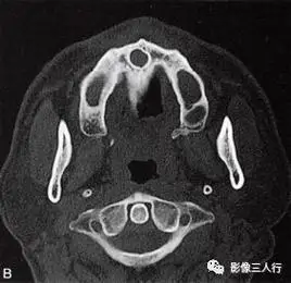 深度学习鼻腭管囊肿的病理与临床特点及ct表现建议收藏