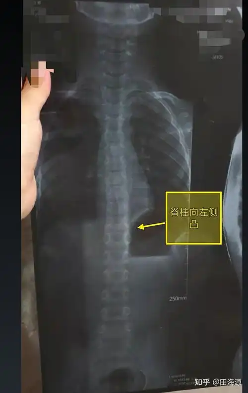 给母亲带来的焦虑青少年脊柱侧弯