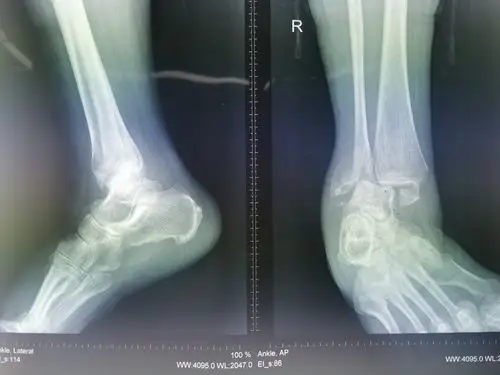 踝关节骨折脱位