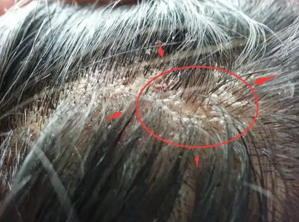 脂溢性皮炎的症状