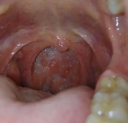 喉咙长了个囊肿图片77