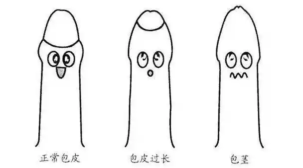 宝宝隐性包茎怎么办(宝宝隐匿性包茎是怎么回事)