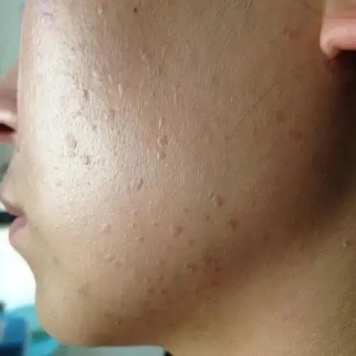 发现他脸上长的不是青春痘,而是扁平疣