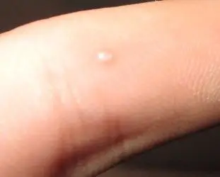 手上脚上长一些白色突起,不疼不痒的 什么病啊?