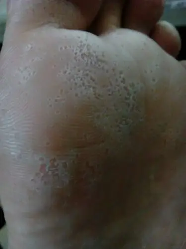 脚底有很多一点一点的小洞,就那些地方很臭,像脚气但是一点也不痒.