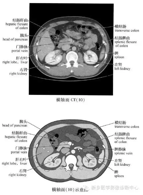 史上最全腹部横断位解剖详细标注