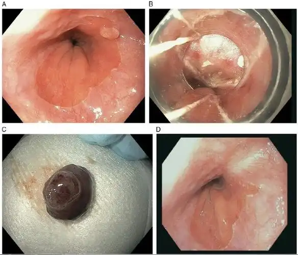 综述:食管癌的早期内镜治疗