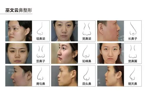 下面,找了鼻子形状的大致分类,大家对号入座,看看自己属于哪种鼻形?
