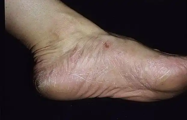 足藓初期症状图片 (6)