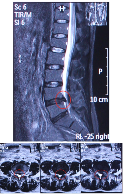 腰椎间盘突出 - 好大夫在线
