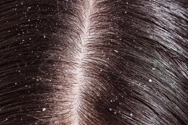 头皮屑多洗不掉,用这3招,帮你解决头屑烦恼!