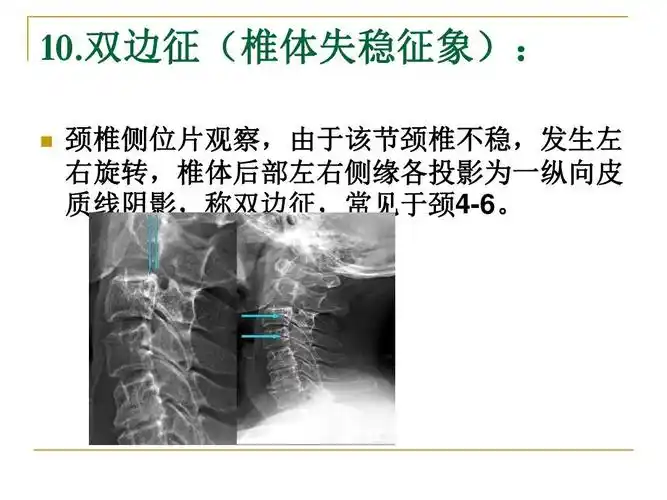 颈椎病x线诊断ppt