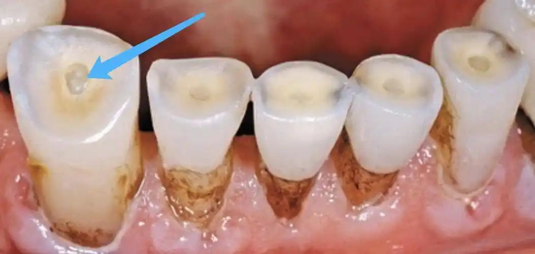 下图这个病例[3],就是因咀嚼习惯造成了牙本质磨损,都快暴露了肯定是