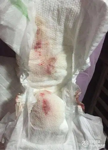 乳腺肿大和假月经