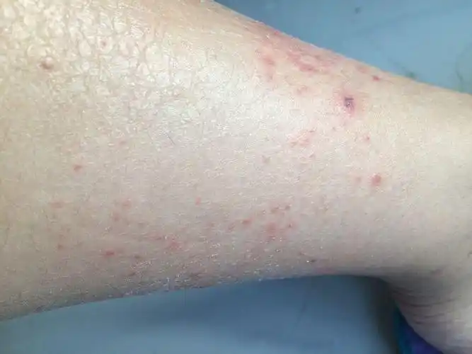 艾滋病水泡特点图片