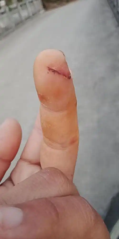 为什么我的手擦药都一个星期了,还是感觉伤口那部分摸着有点硬,感觉有