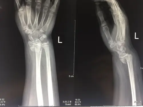 骺损伤,手法复位,完美愈 (原创)_桡骨
