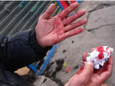 梦见摔倒手出血