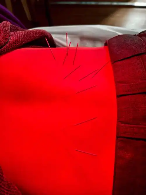 针灸  #火罐  #急性腰扭伤  #第三腰椎横突综合症