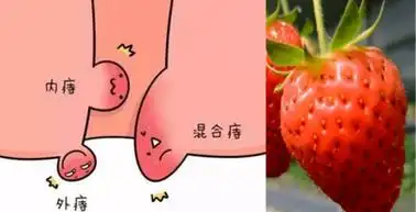 痔疮症状图片?痔疮吃什么食物好?_腾讯新闻