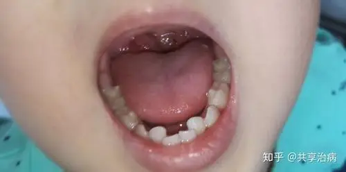 小儿扁桃体肿大严重