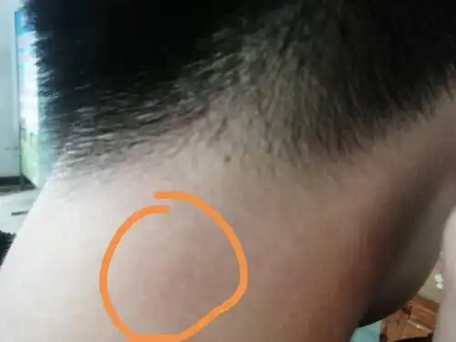 这是淋巴结肿大吗?为什么右边这里按来按去会痛,颈椎病会这样吗?