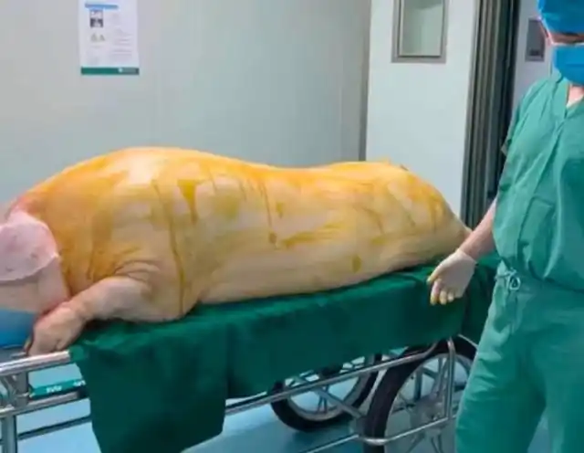 烧伤病人手术移植猪皮惹争议,医院回应_费用