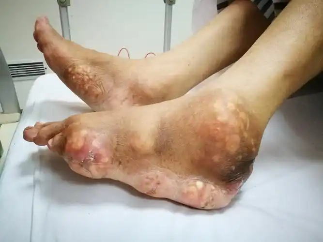 谨记痛风需正规治疗