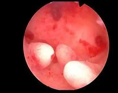 子宫出血量多者 2.