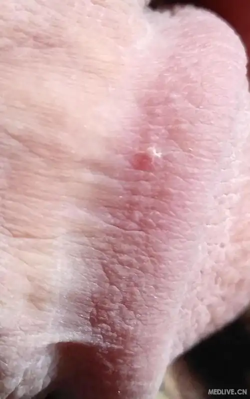 八月三日阴囊瘙痒,发现阴囊长了很多小疙瘩,龟头上面也有.1 楼