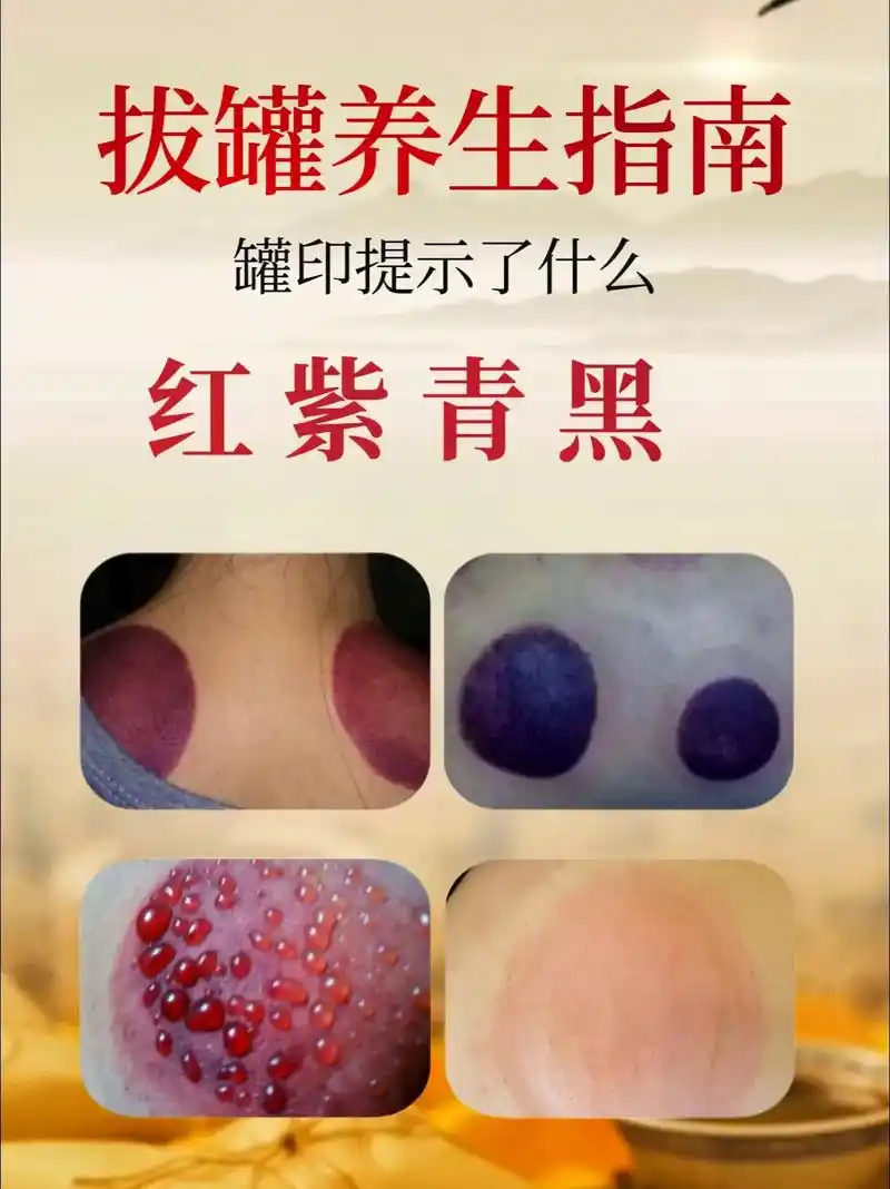 拔罐养生指南—不同罐印代表了什么,快来看看吧!#拔罐 #拔罐 - 抖音