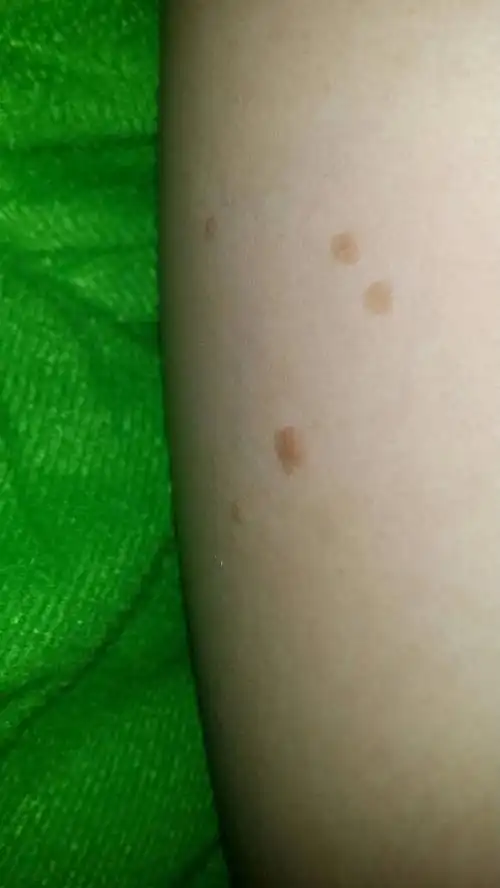 腿上的扁平疣怎么去除.