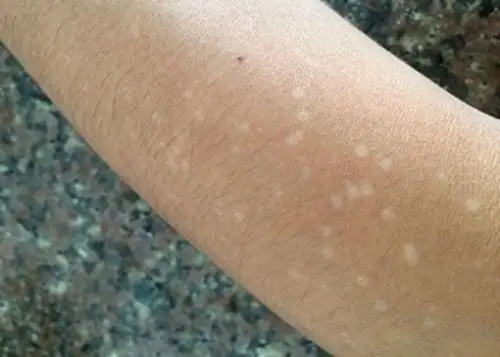 贫血痣图片 (36)