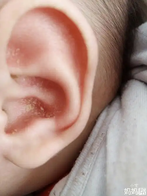 小孩怎么这么多耳屎呀