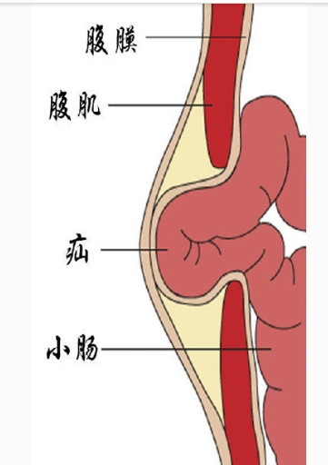 腹股沟疝图片 (14)