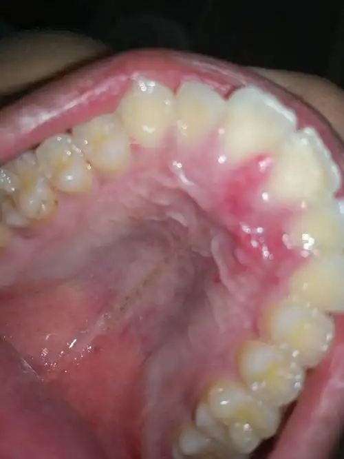 口腔上颚红肿是上火了么