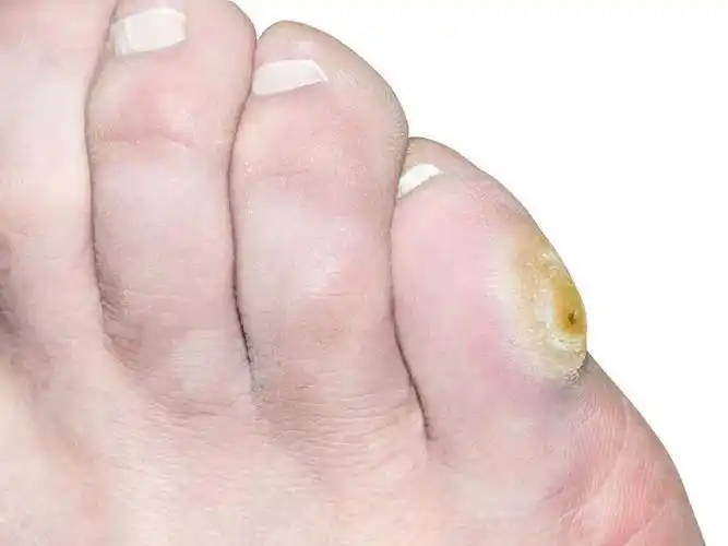 头内侧长得是鸡眼吗 以前好了现在又有了脚上长的这是鸡眼还是刺猴呢?