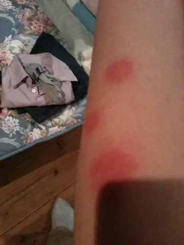 四肢突然出现圆形红疹是什么原因?很痒