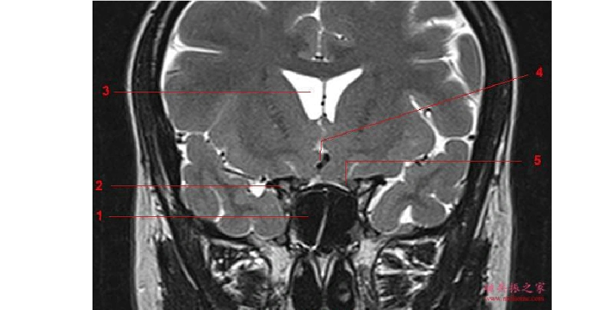 (精选)鞍区垂体mri解剖