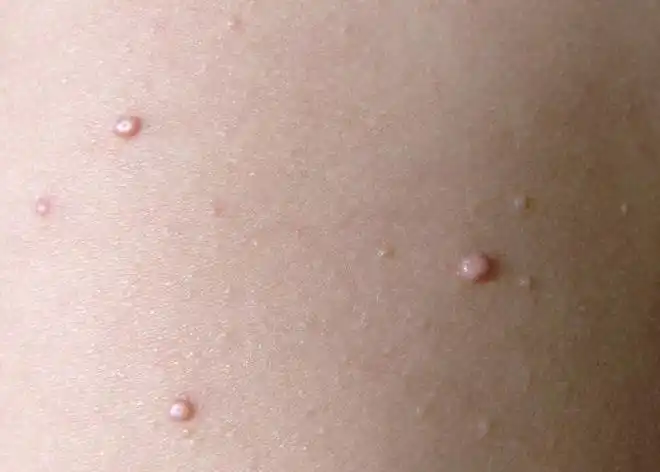 疣,俗称为"瘊子",是人乳头状瘤病毒感染表皮引起的.