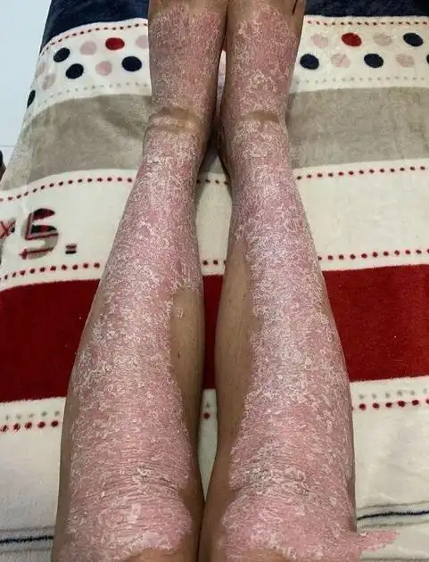点滴状银屑病图片及症状图片_银屑病求医网