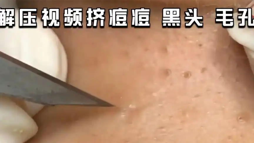 解压视频挤痘痘 黑头 毛孔 强迫症的福音 胆小慎入