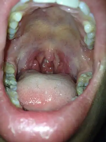 软腭硬腭都发黄 还有点痛怎么回事 求救