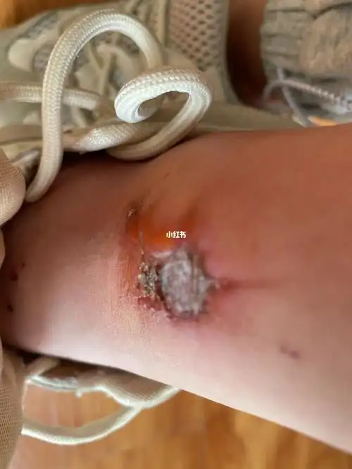 烫成这样怎么办_烟花_烫伤_团建_医疗健康_医疗健康其他