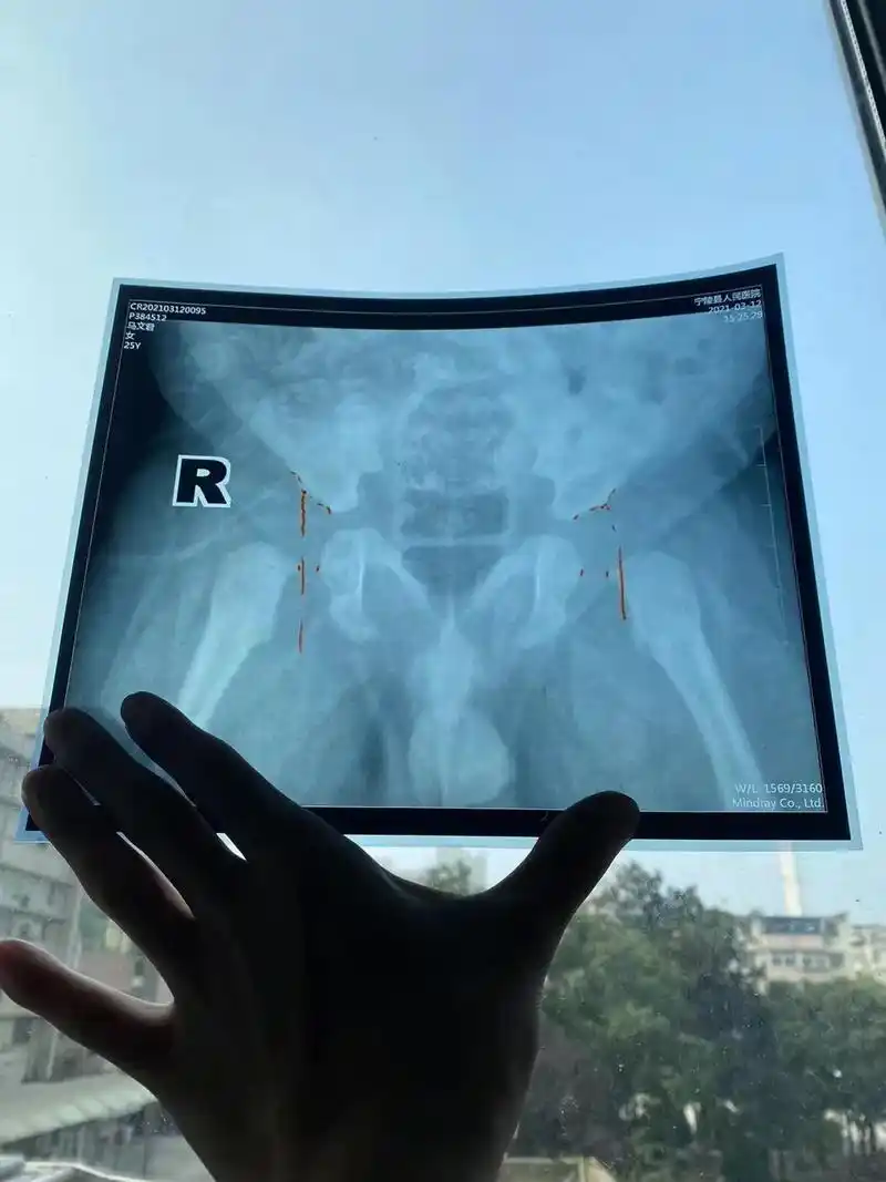 这是又一个髋关节半脱位合并髋关节发育不良的小宝宝从两个多月( - 抖