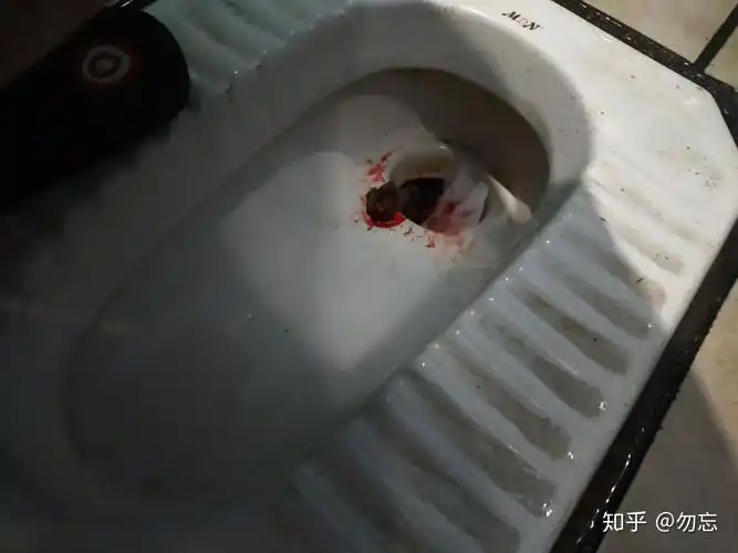 痔疮手术后水肿了 - 知乎