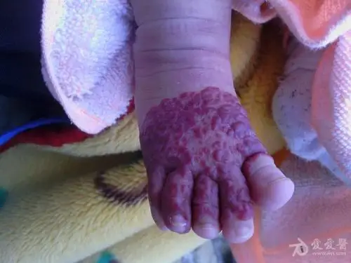 求助小女足部血管瘤