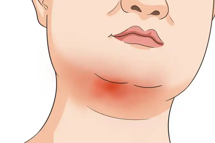 下颚淋巴肿胀疼痛怎么回事图片