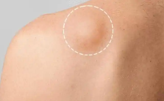 女子误诊脂肪瘤,确诊后1个月去世,医生无奈:发病率低的转移癌