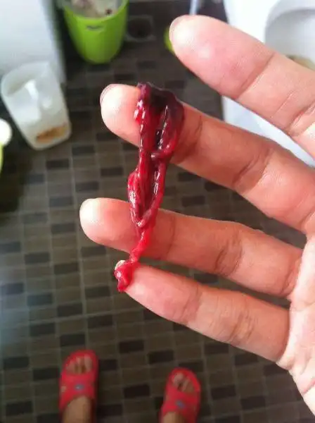 月经第三天 有像肉一样的血块 没有怀过孕 个人卫生也很注意